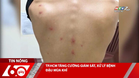 Xem Clip TP.HCM TĂNG CƯỜNG GIÁM SÁT, XỬ LÝ BỆNH ĐẬU MÙA KHỈ HD Online.